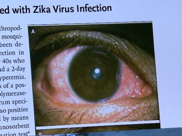 Vírus da zika provoca infecção ocular em adultos ligada a glaucoma, diz USP