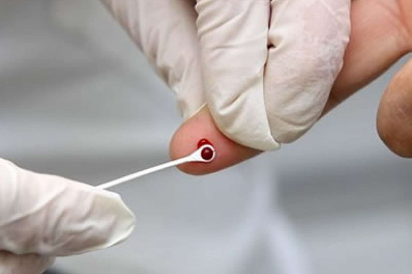 Teste rápido para detectar infecção pelo vírus da hepatite é incluído no SUS
