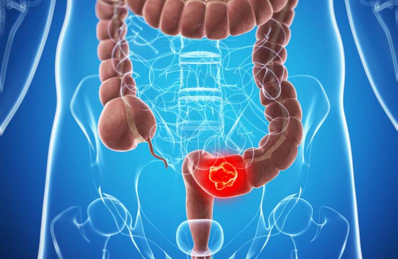 Câncer colorretal tem 90% de chance de cura se descoberto no início, diz médico
