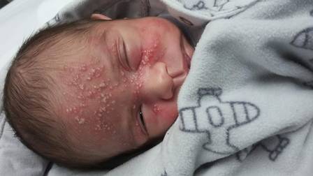 Mãe alerta para riscos de beijos em bebês após seu filho pegar herpes com 17 dias