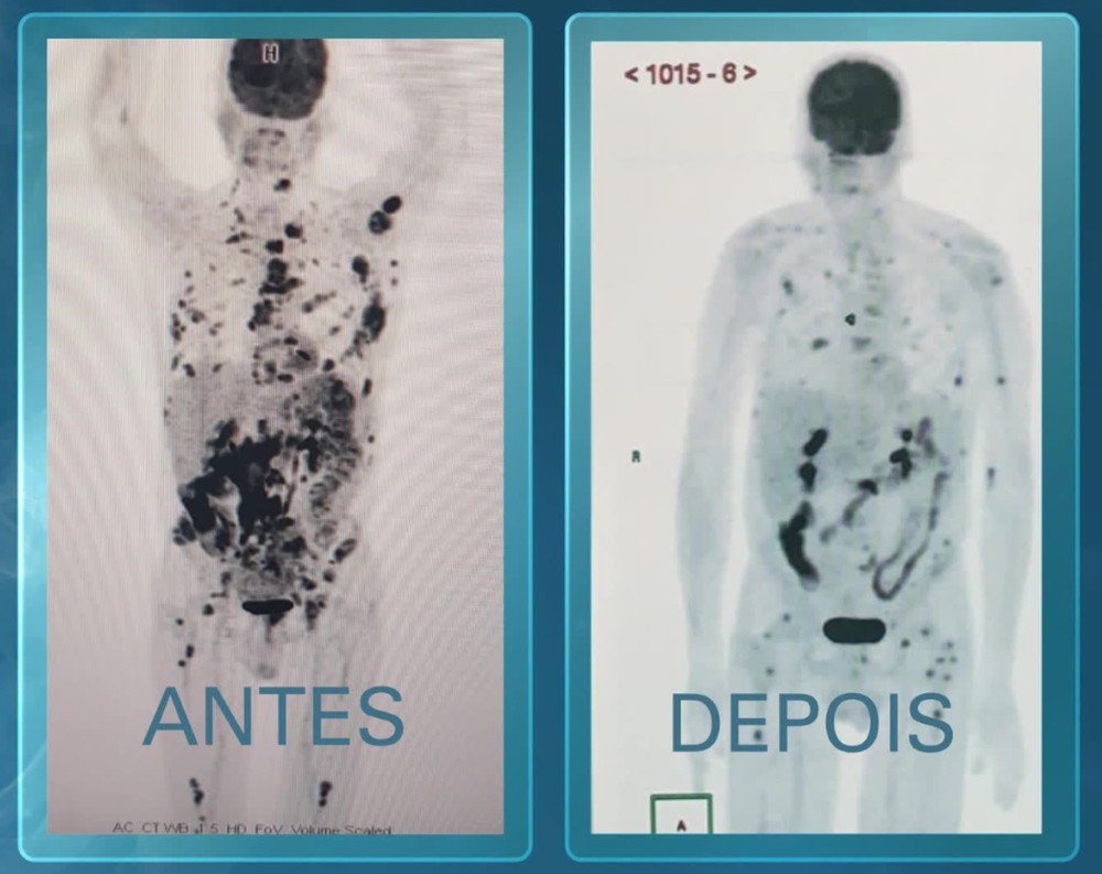 Imagens mostram regressão de câncer em paciente terminal após tratamento pioneiro na América Latina