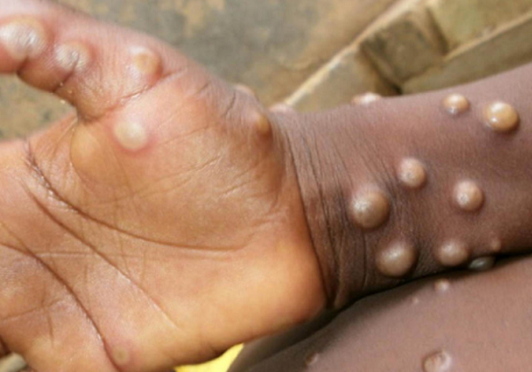 Com 709 casos de mpox no Brasil, ministério convoca reunião