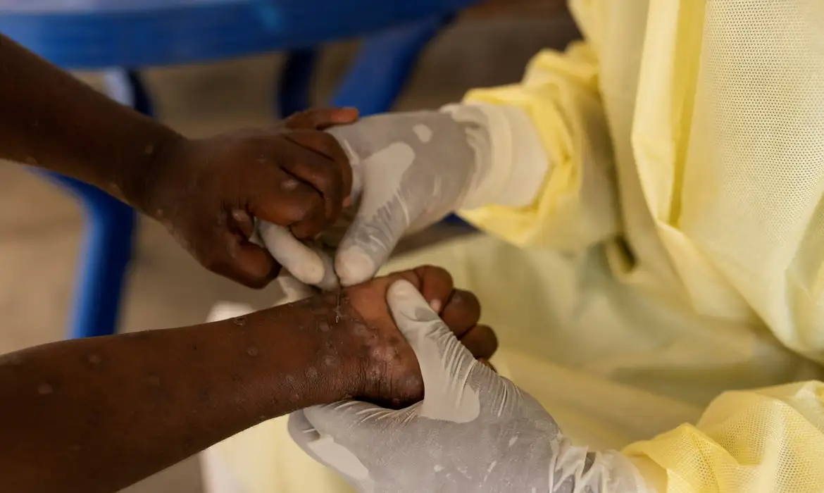 Casos de mpox registrados no Brasil em 2024 já superam o total de 2023