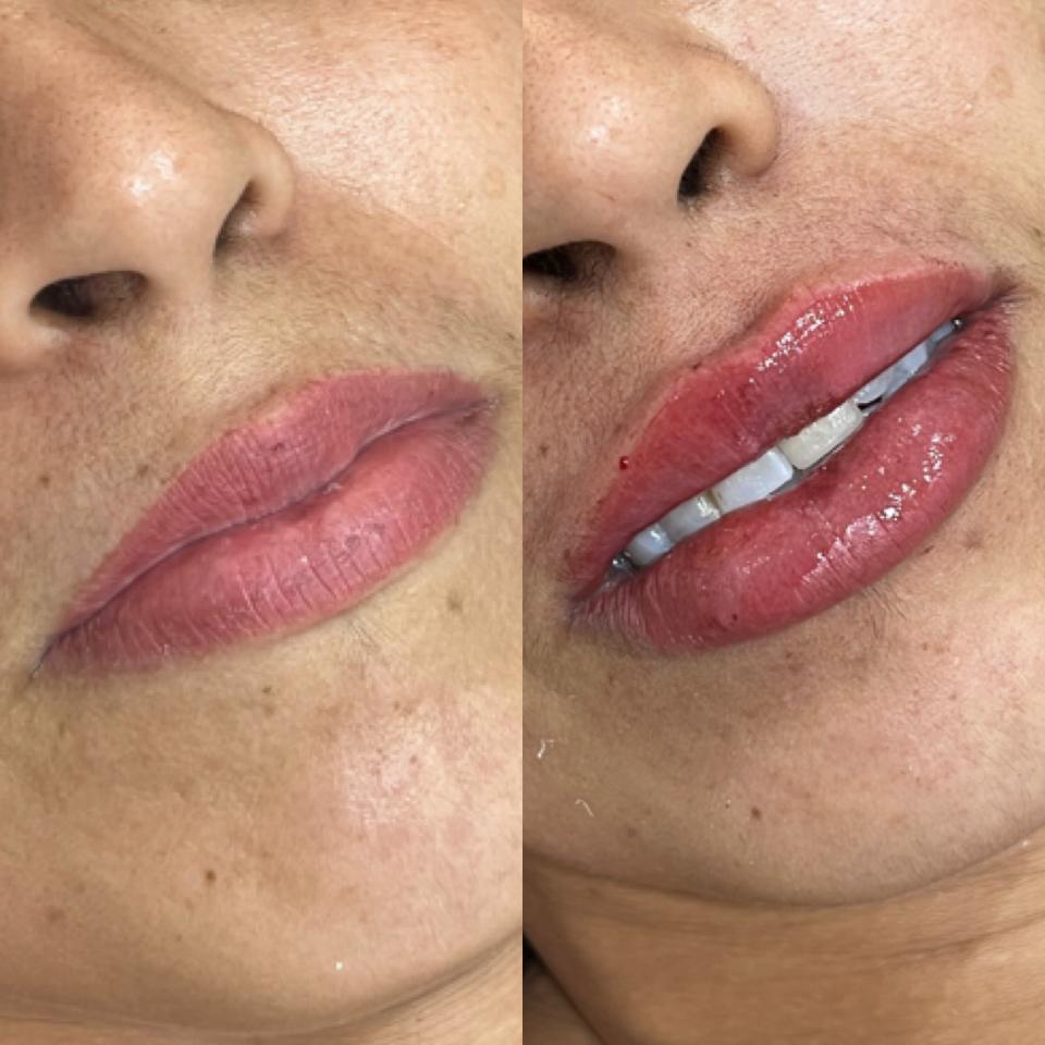 Preenchimento labial: mais beleza e autoestima em alta