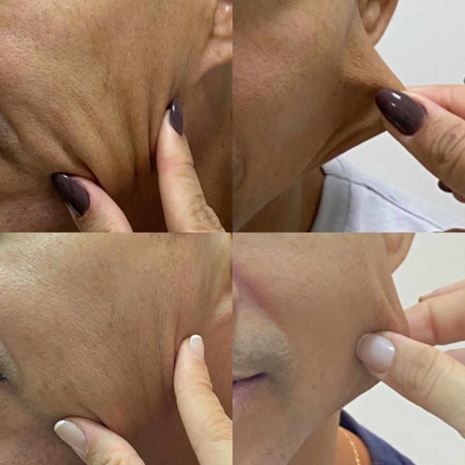 Bioestimuladores injetáveis ganham destaque nos cuidados com a face e o corpo