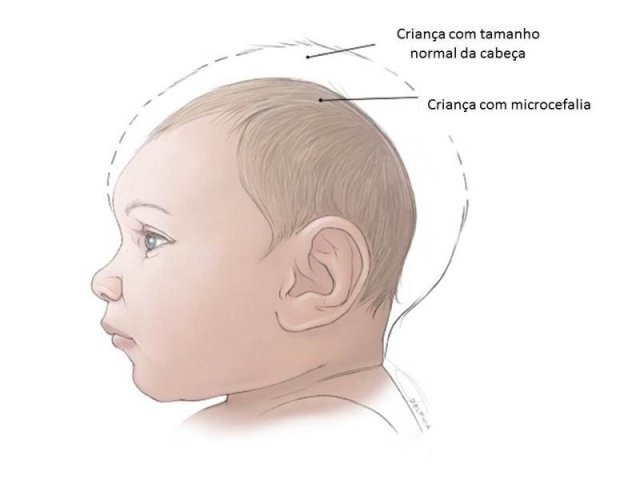 Microcefalia de bebês e os criminosos administrativos